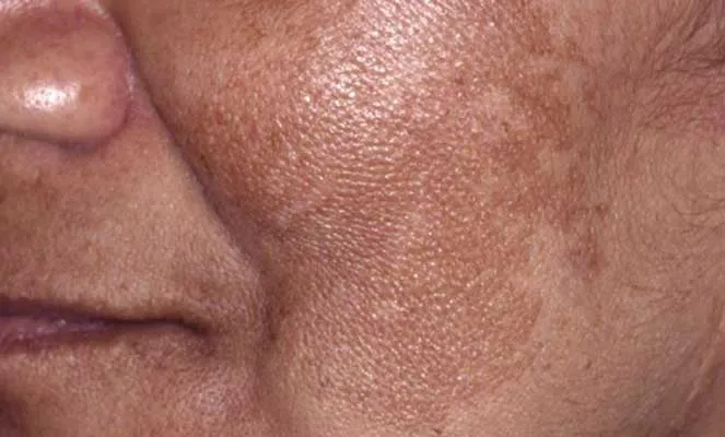compressed_1753453905100_melasma.jpg